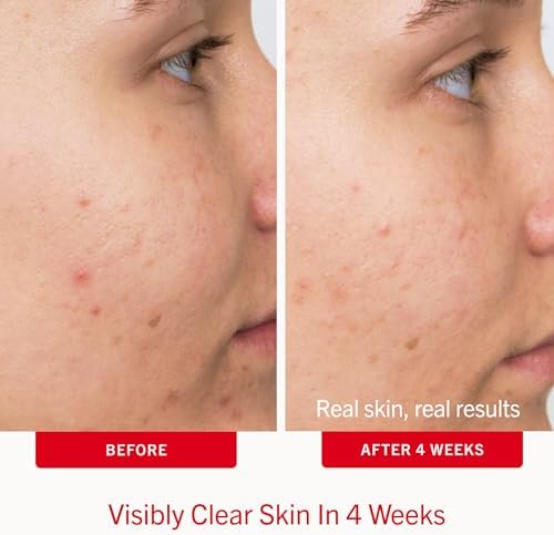 First Aid Beauty Acne Treatment Pads, 2% Salicylic Acid