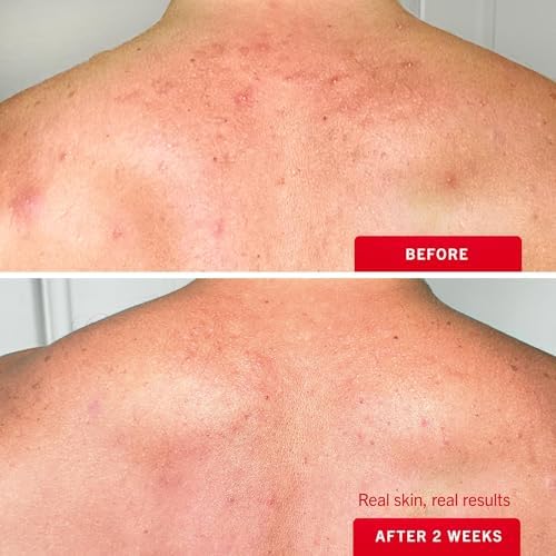 First Aid Beauty Body Acne Spray, 2% Salicylic Acid, 3 oz