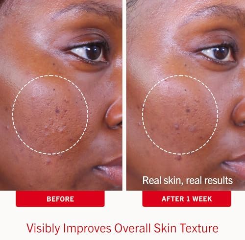 First Aid Beauty Acne Treatment Pads, 2% Salicylic Acid